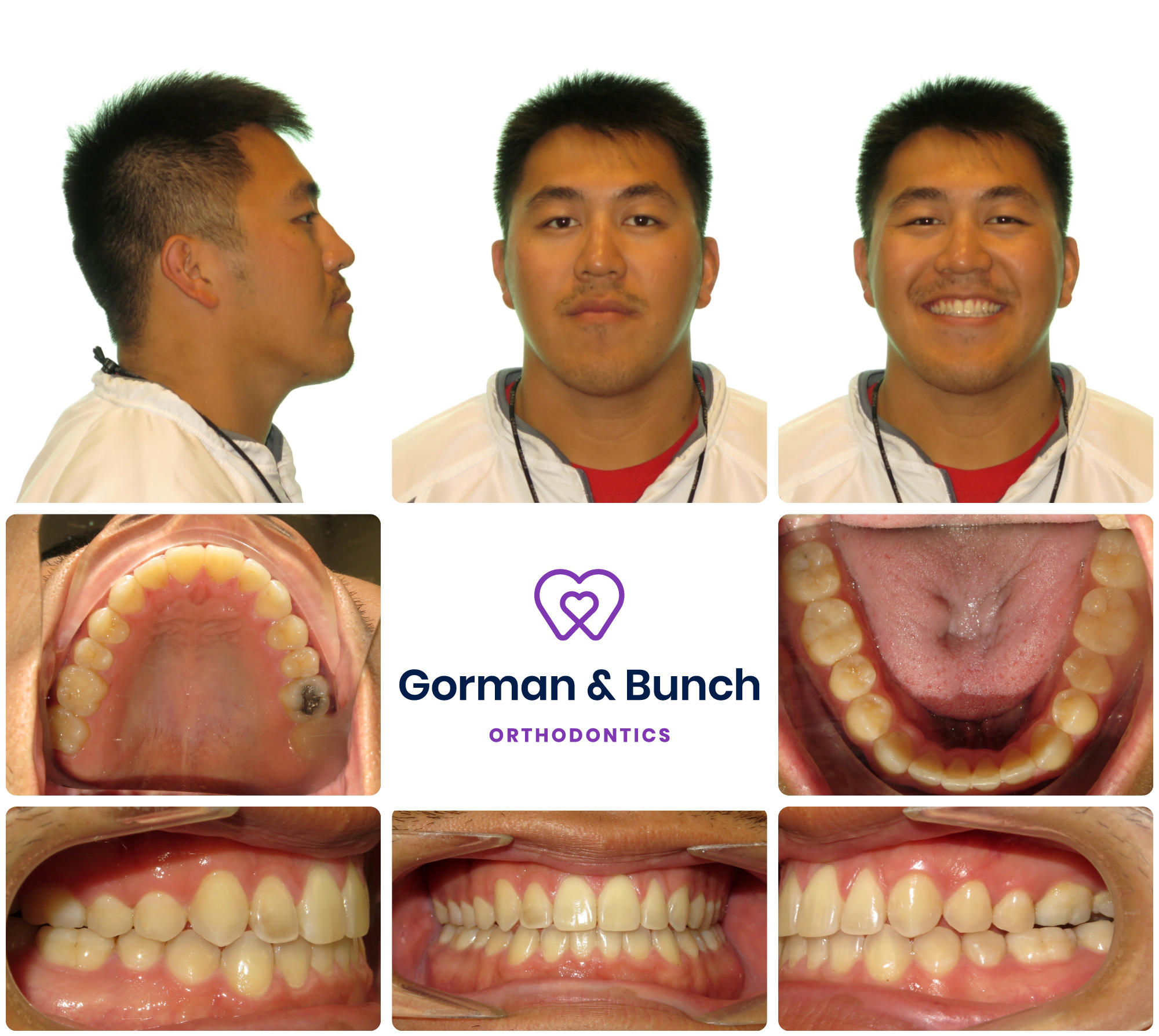 invisalign before and after - underbite - carmel indiana - cc - 2